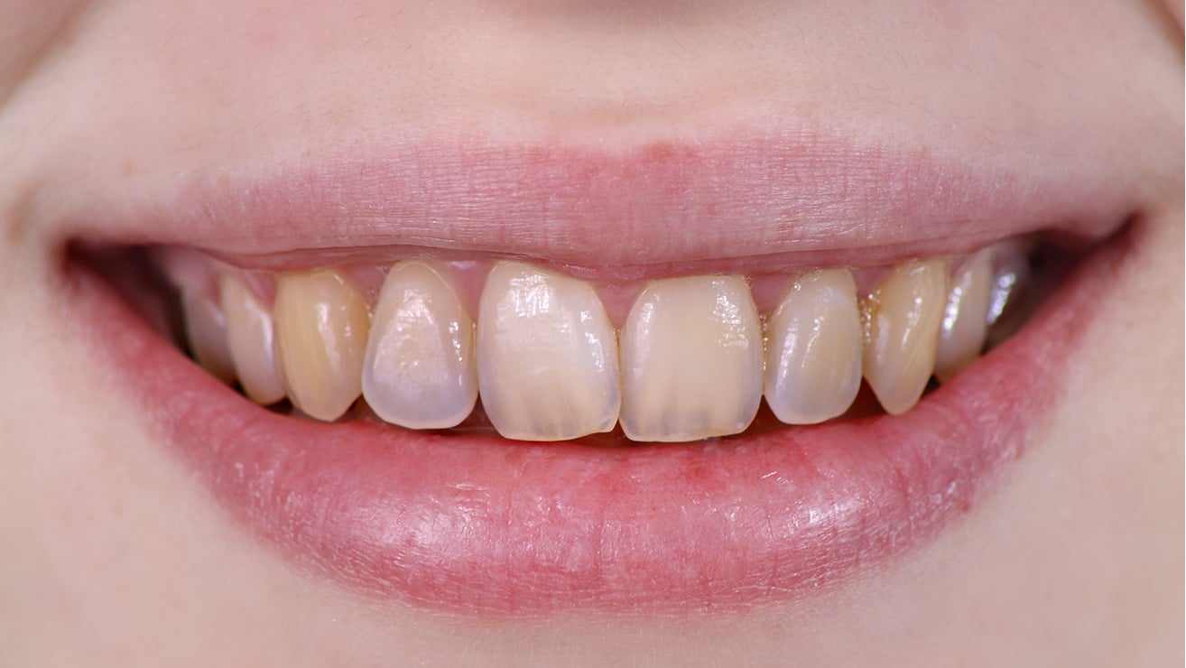 Picture of Teeth Without Enamel